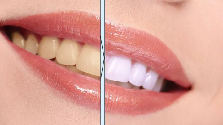 SmileWorks™ Długopis Wybielający