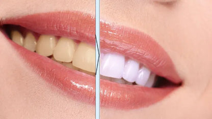 SmileWorks™ Długopis Wybielający